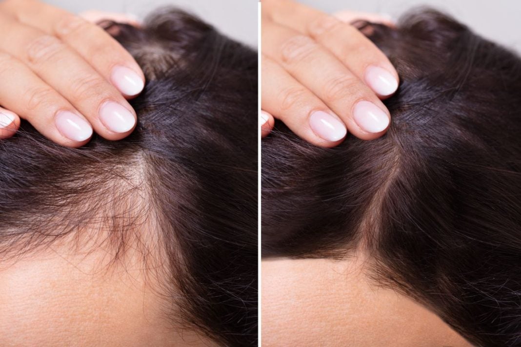 Estas vitamina ayudan a evitar la caída del cabello