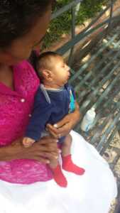 niño con microcefalia Honduras