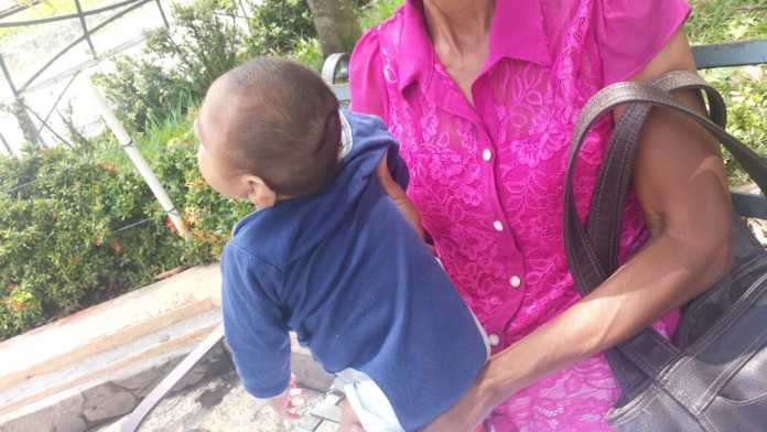 niño con microcefalia en Copán
