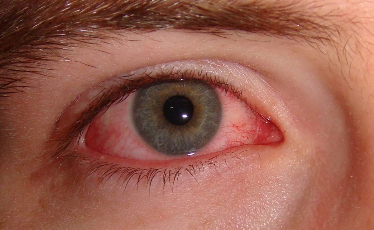 La conjuntivitis se hace presente como un color rojizo en los ojos. Asimismo, causa ardor y en ocasiones, picazón.