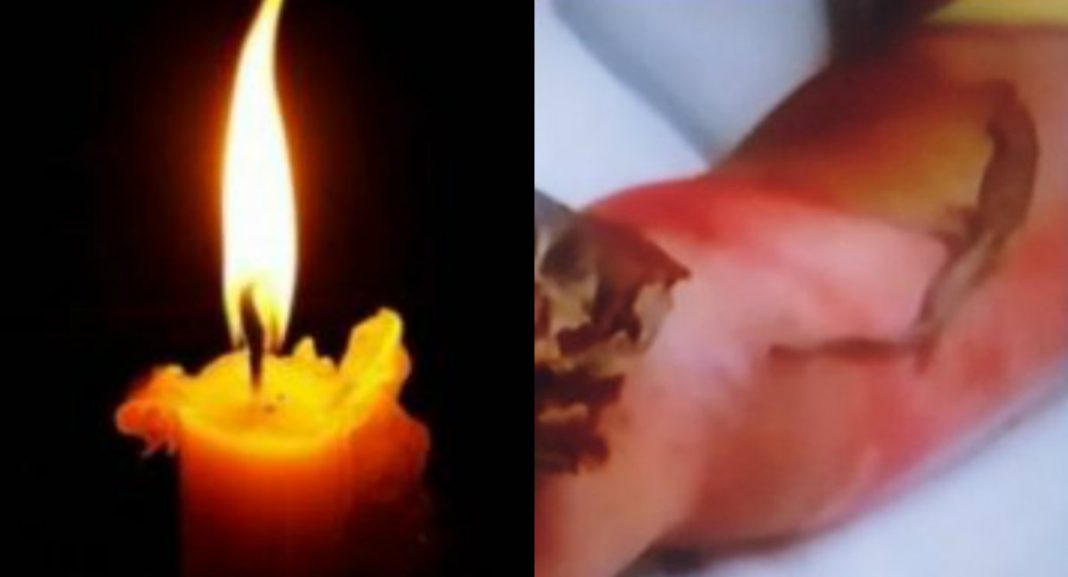niño quemado por candela en su cama