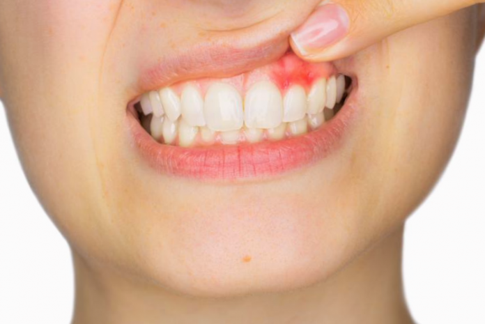 gingivitis gingivitis