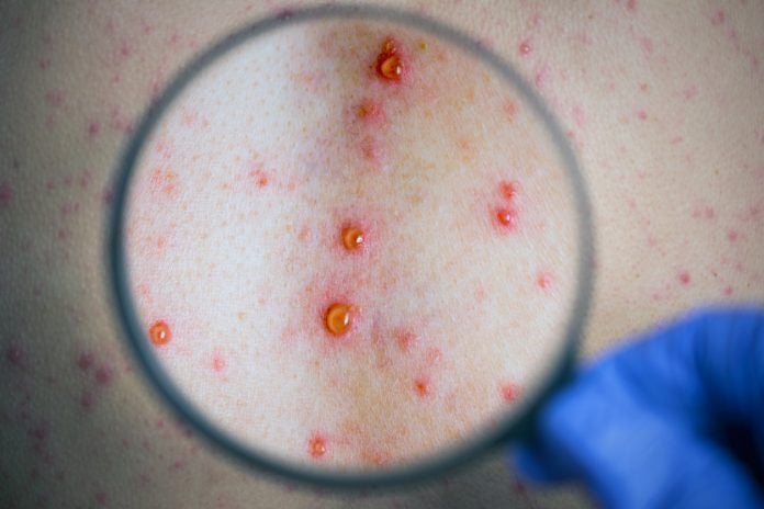Varicella Culebrilla