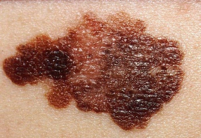 Cáncer de piel Cáncer de piel