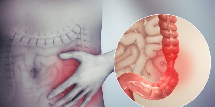 síndrome del colon irritable síndrome del colon irritable