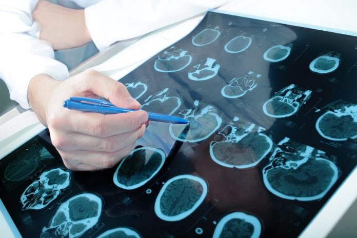 covid-19 y parkinson covid-19 y parkinson
