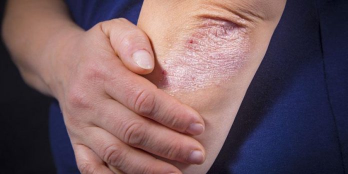 Psoriasis y artritis psoriásica Psoriasis y artritis psoriásica