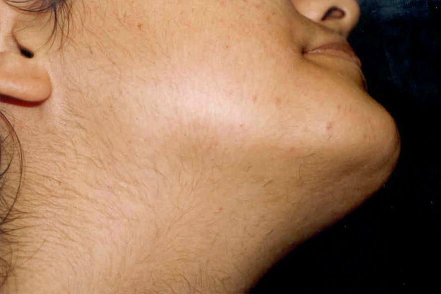 Vello facial, acné, sobrepeso y periodos irregulares: Síntomas del Ovario Poliquístico o SOP