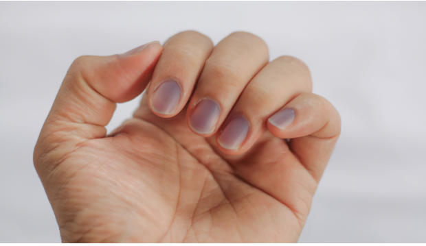 9. Anemia and Dark Nail Beds - wide 2