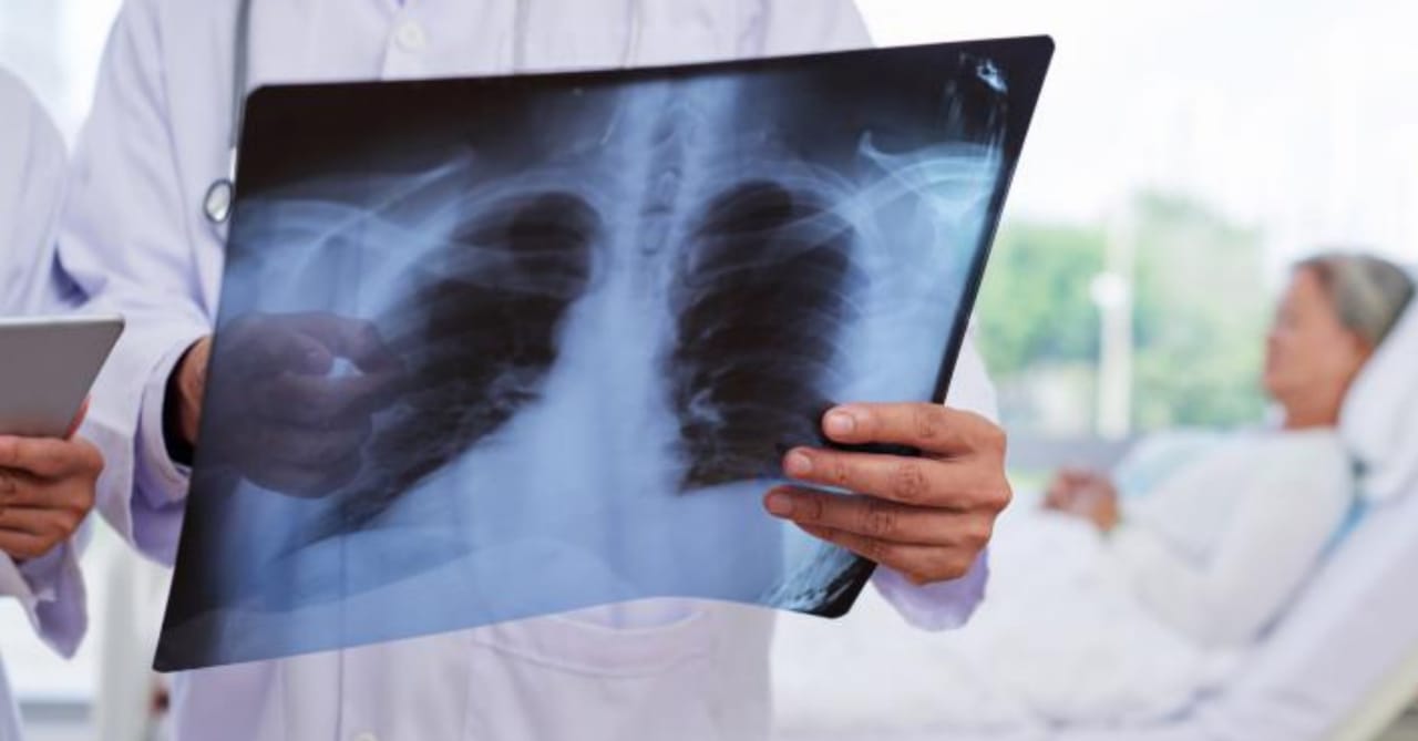 La enfermedad de tuberculosis en los pulmones puede causar síntomas como los siguientes: Tos intensa que dura 3 semanas o más. Dolor en el pecho. Tos con sangre o esputo (flema que sale desde el fondo de los pulmones).