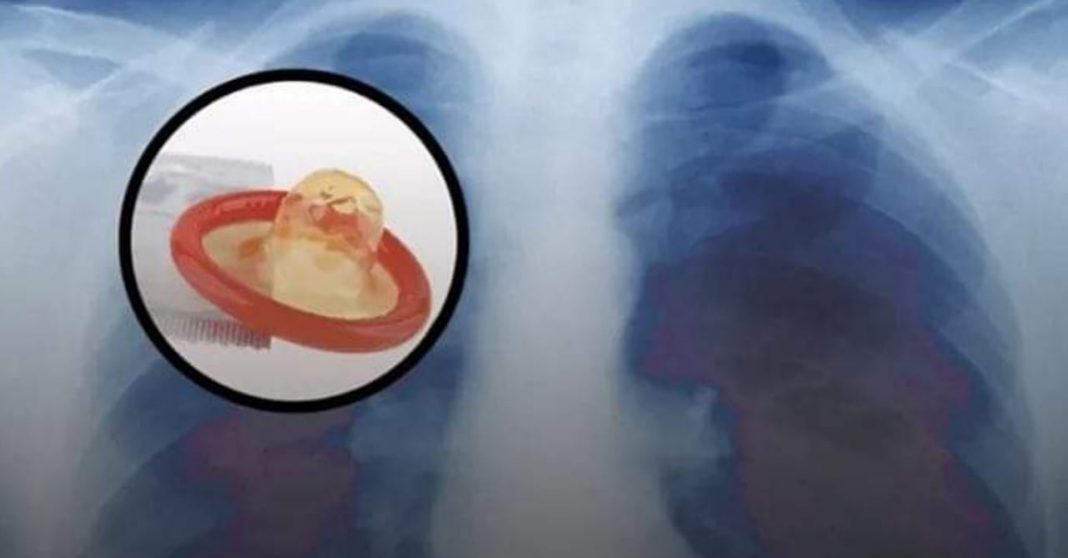 mujer condón pulmones tuberculosis