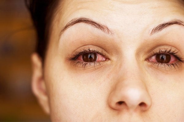 Las causas de los ojos llorosos son múltiples; algunas sin complicaciones y otras que encierran algo de gravedad.