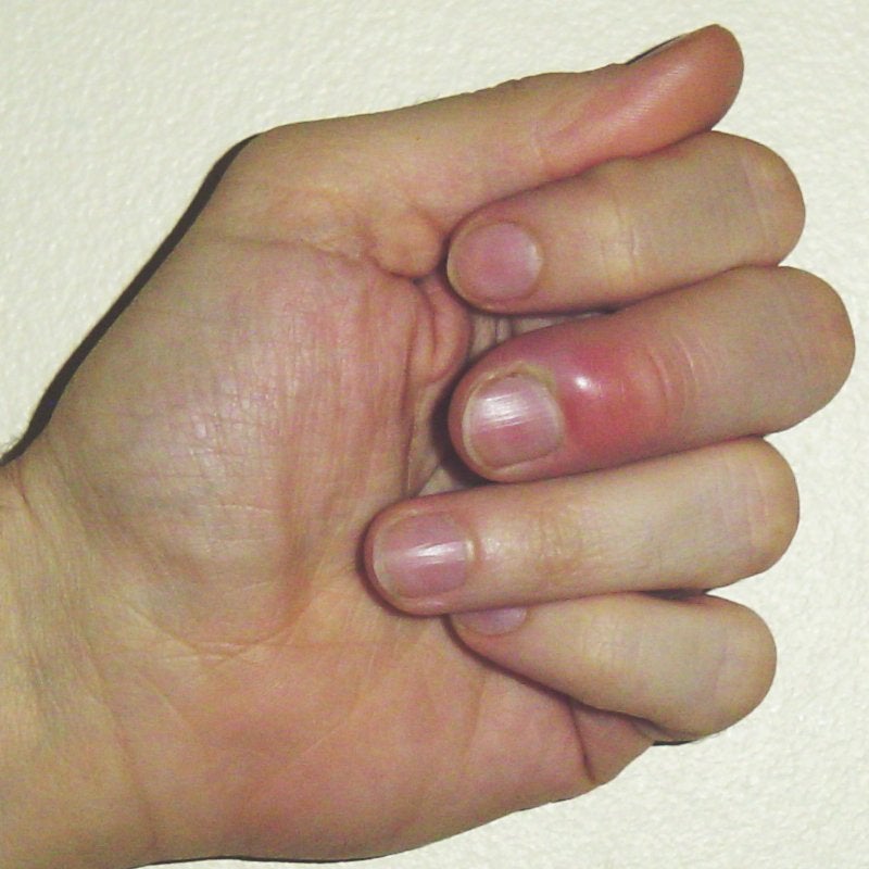 Detalle 36+ imagen efectos secundarios de uñas acrilicas