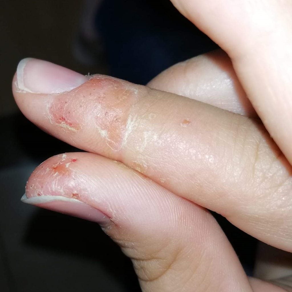 Efectos secundarios al aplicar excesivo acrílico en las uñas