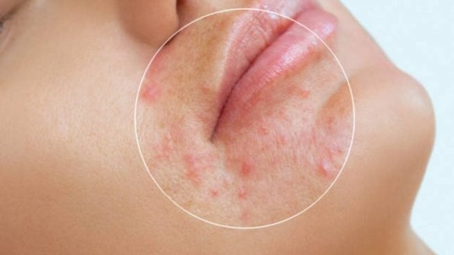 evitar manchas en la piel por el acné