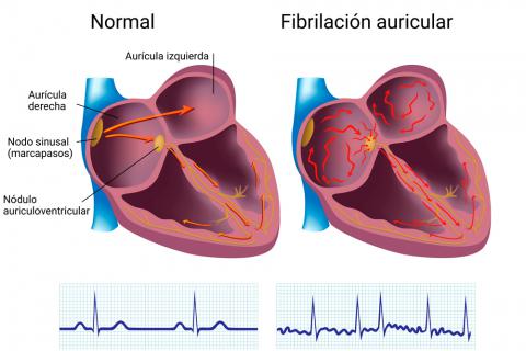 Explicación de la fibrilación auricular.