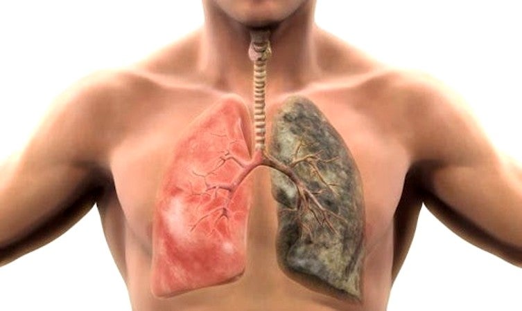 síntomas de cáncer de pulmón