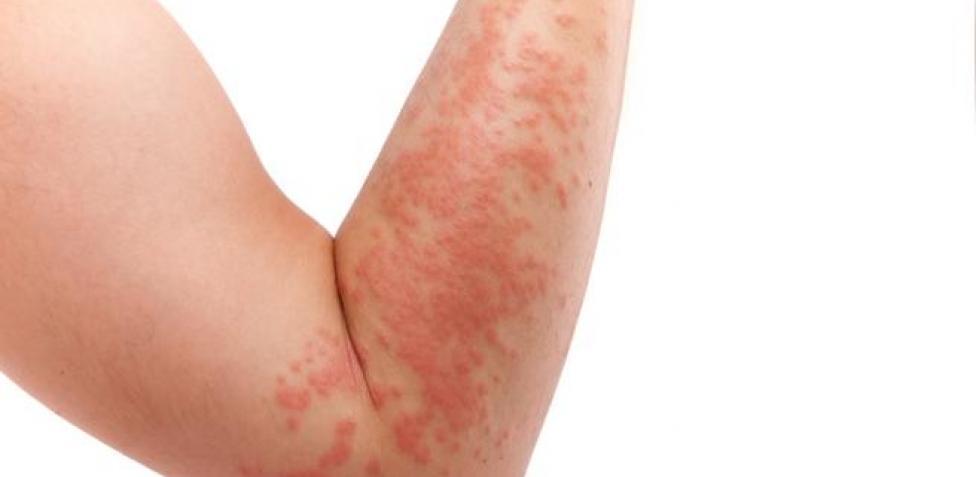 alergias de la piel más comunes
