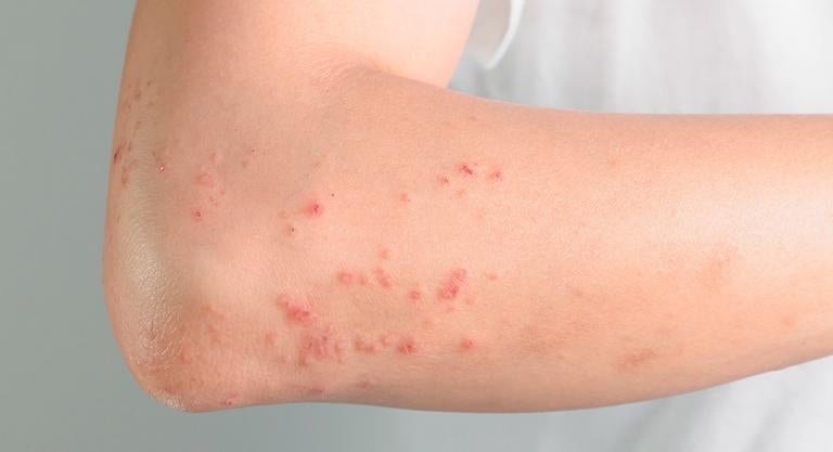 En la piel aparecen varios síntomas visibles.