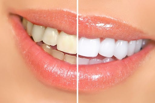 trucos para dientes más blancos