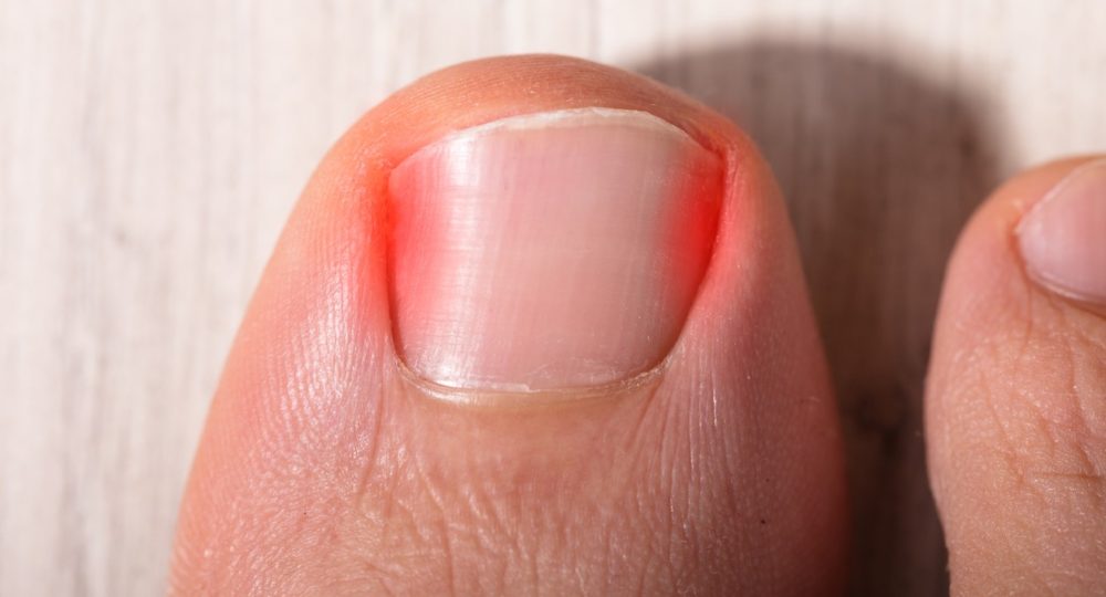 Consejos para evitar las uñas encarnadas