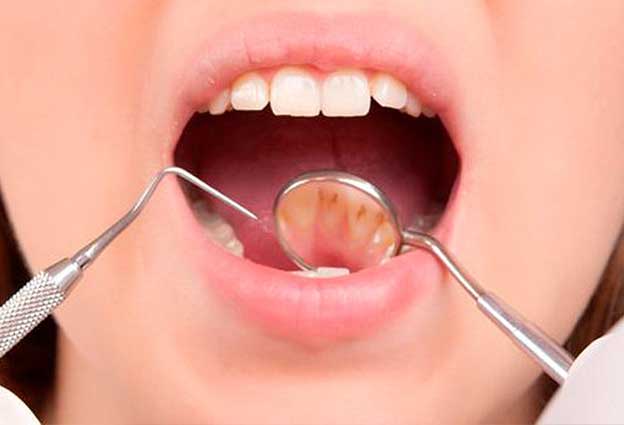 remover el sarro en los dientes