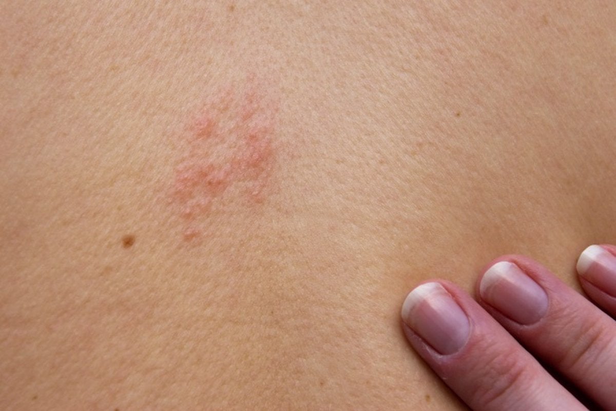 Cualquier persona que haya sufrido de varicela puede desarrollar herpes zóster.