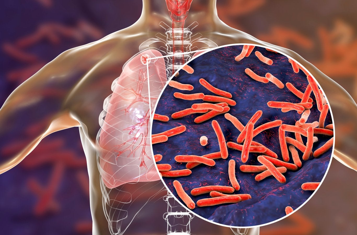 La tuberculosis se transmite de una persona a otra a través de gotitas de aerosol suspendidas en el aire expulsadas por personas con enfermedad pulmonar activa.