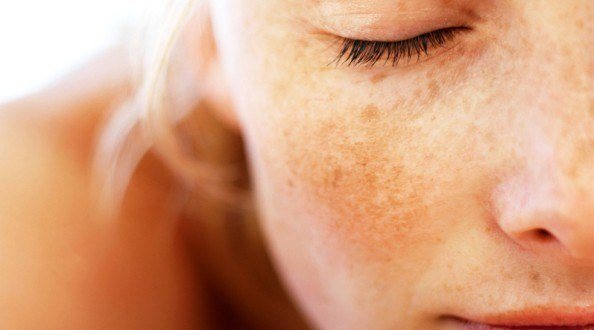 La hiperpigmentación puede aparecer en la cara y las manos, o en las zonas del cuerpo expuestas al sol.