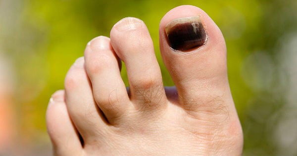 Muchos corredores, principalmente, saben de sobra lo que es tener las uñas negras de los pies. 