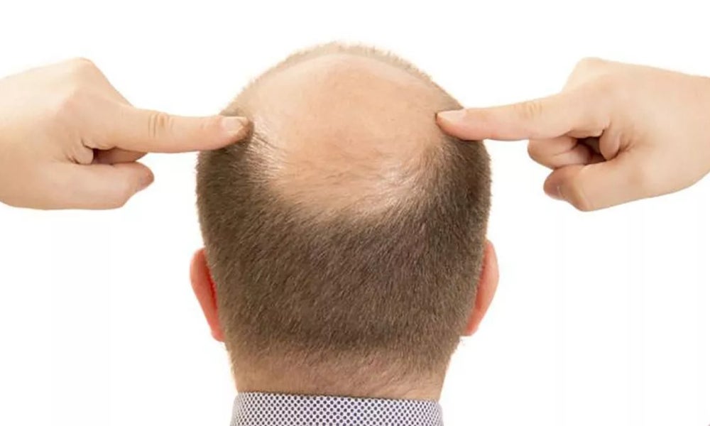 La alopecia es una enfermedad que se puede reflejar en hombres y mujeres.