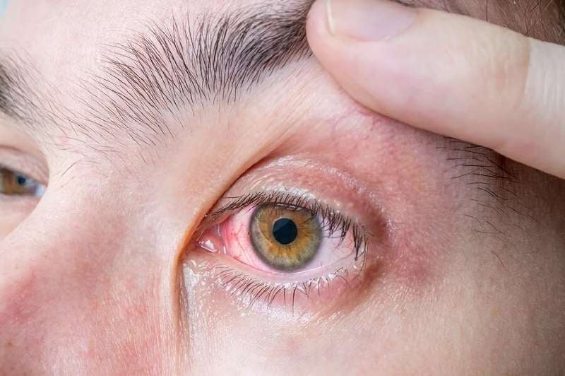 qué es melanoma ocular
