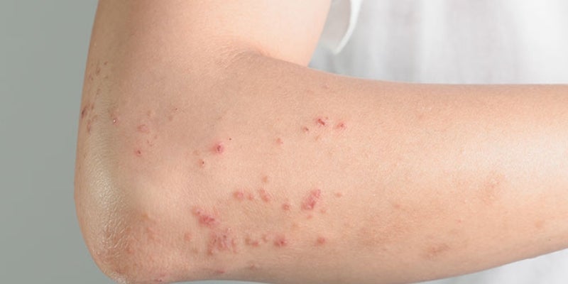 La ronchas rojas son el principal síntoma de la alergia al sudor. 