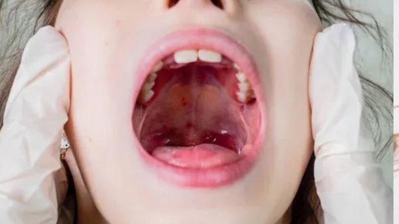 tratamientos para pus en garganta