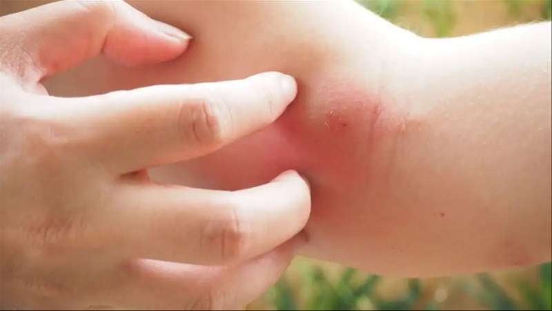 Al rascar puede hacer que los virus y bacterias presentes en nuestras uñas entren a través de la herida abierta por el insecto.