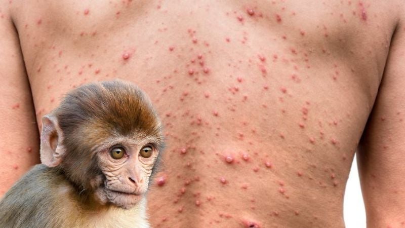 Lugares riesgo viruela mono