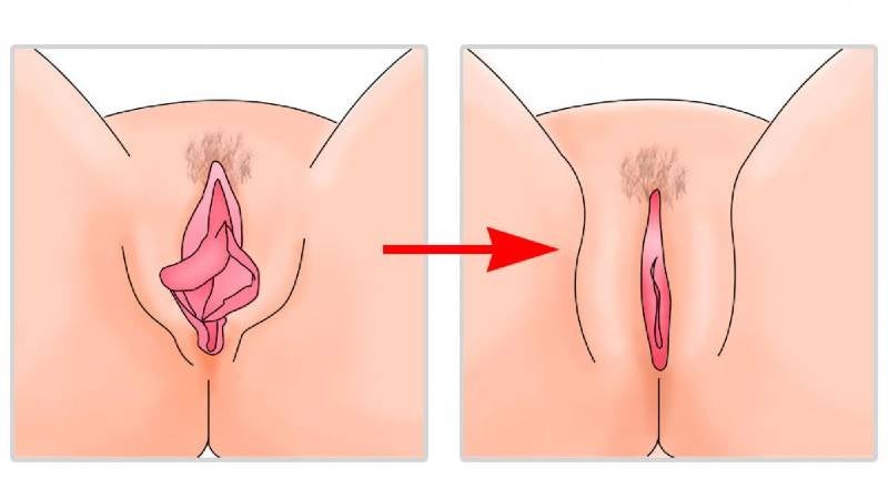 Rejuvenecimiento vaginal