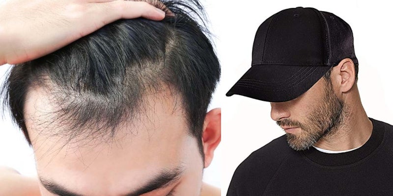 Los médicos indicaron que el uso de gorra empeora la pérdida de cabello.