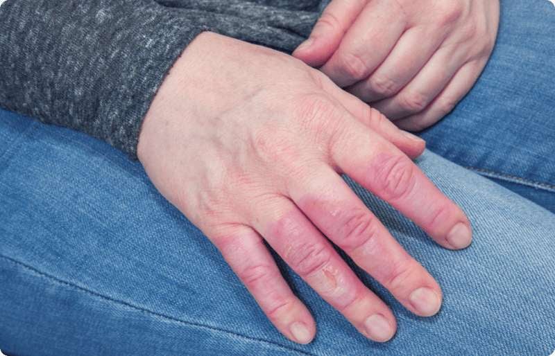 Por qué se hinchan los dedos de las manos