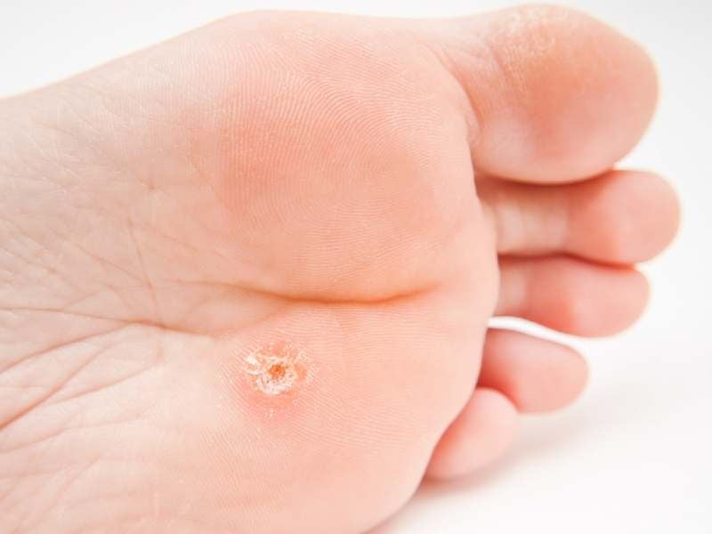 If warts persist or are very painful, other procedures are used, such as laser removal, nitrogen freezing, and then excision.