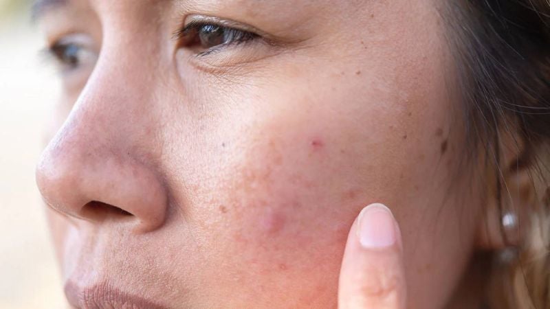 consecuencias de cremas en la piel