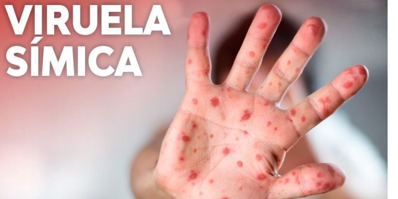 Casos de viruela símica en El Salvador suman 104; no hay fallecidos