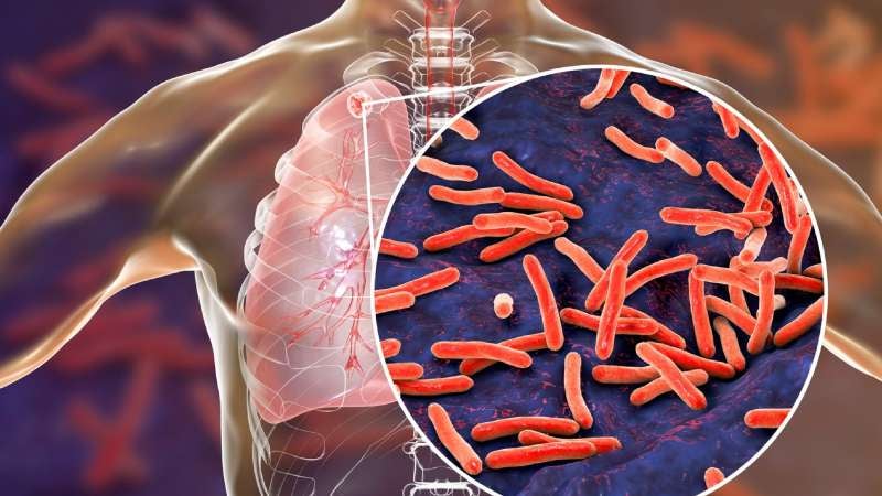 Casos de tuberculosis en Choloma
