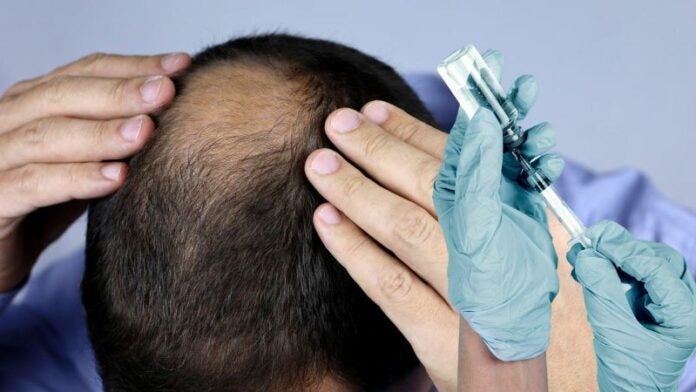 Vacuna contra la alopecia promete dar un giro al mundo capilar