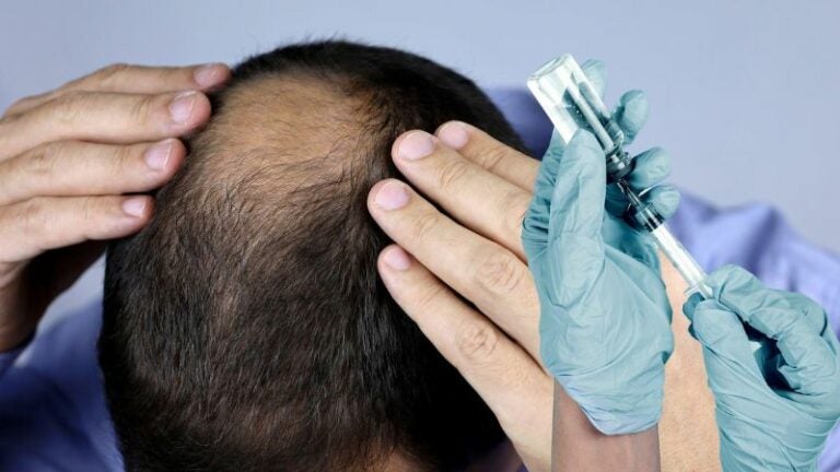 Vacuna contra la alopecia promete dar un giro al mundo capilar