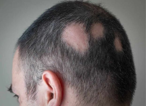 Vacuna contra la alopecia promete dar un giro al mundo capilar