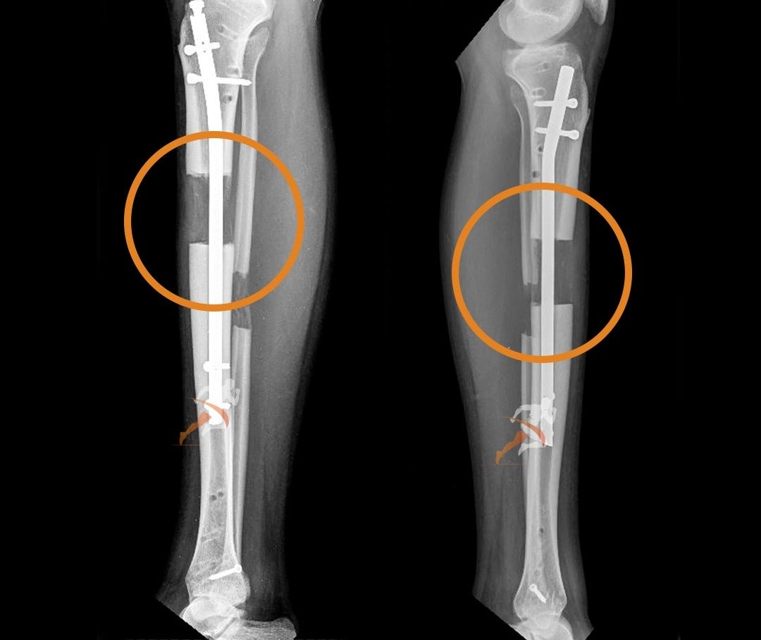 Cirugía de alargamiento de piernas