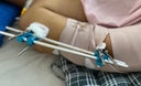 fractura1