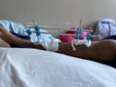 fractura2