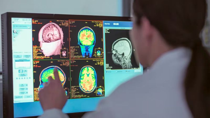 FDA respalda beneficios de un medicamento para el Alzheimer